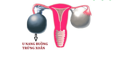 U nang buồng trứng xoắn có nguy hiểm không?